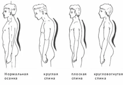 Кругловогнутая спина що це таке, як формується, лікування, вправи для профілактики (формується) Кругловогнутая спина що це таке, як формується, лікування, вправи для профілактики