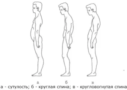 Кругла спина у дитини що це таке, причини появи, лікування вправами (лікування) Кругла спина у дитини що це таке, причини появи, лікування вправами