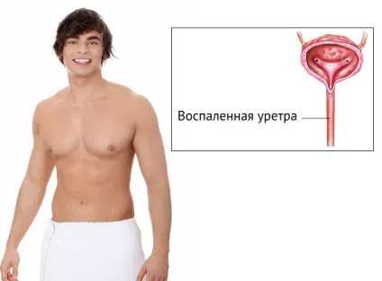 Кров з уретри у чоловіків причини, лікування