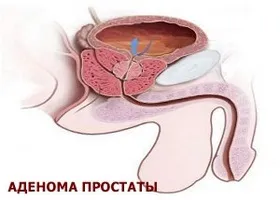 Лікування аденоми простати за допомогою фізіоаппаратов (простати) Лікування аденоми простати за допомогою фізіоаппаратов