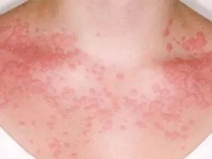 Лікування артрозу желатином переваги продукту, побічні ефекти (артрозу) Лікування артрозу желатином переваги продукту, побічні ефекти