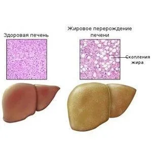 Лікування фіброзу печінки народними засобами - здоров'я інфо (лікування) Лікування фіброзу печінки народними засобами - здоров'я інфо