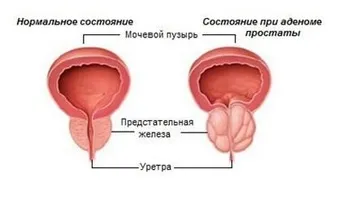 Лікування аденоми простати за допомогою фізіоаппаратов (допомогою) Лікування аденоми простати за допомогою фізіоаппаратов