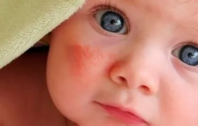 Лікування діатезу у немовлят і новонароджених на обличчі яку мазь вибрати (діатезу) Лікування діатезу у немовлят і новонароджених на обличчі яку мазь вибрати