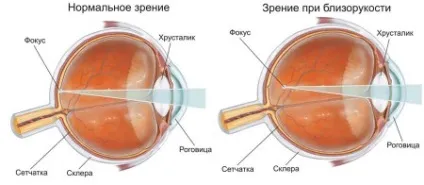 Лікування короткозорості традиційними і сучасними методами (короткозорості) Лікування короткозорості традиційними і сучасними методами