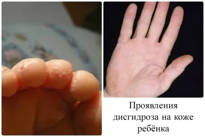 Лікування дисгидроза стоп і кистей рук у дітей