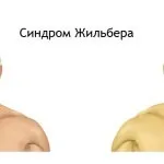 Лікування розсіяного склерозу бджолами - поради