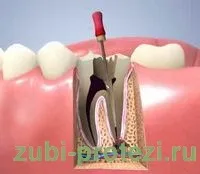 Лікування зубів перед протезуванням (видалення зубних відкладень) Лікування зубів перед протезуванням