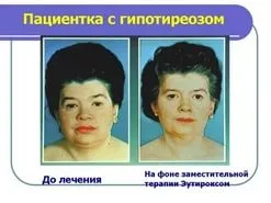 Лікування облисіння бензилбензоату - проекти - причини облисіння у жінок 2 стадія (проекти) Лікування облисіння бензилбензоату - проекти - причини облисіння у жінок 2 стадія