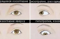 Лікування розходиться косоокості у дітей