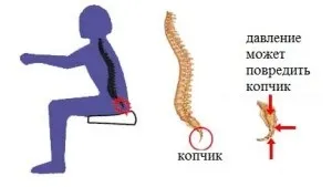 Лікування загину куприка (якість життя пацієнта) Лікування загину куприка