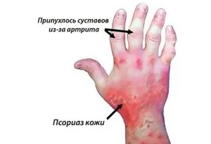 Лікування псоріатічесого артриту (народні методи) (народні) Лікування псоріатічесого артриту (народні методи)