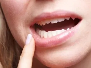 Лікування стоматиту у дорослих медикаментозні препарати, народні засоби (препарати) Лікування стоматиту у дорослих медикаментозні препарати, народні засоби