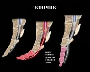 Лікування загину куприка (куприка) Лікування загину куприка