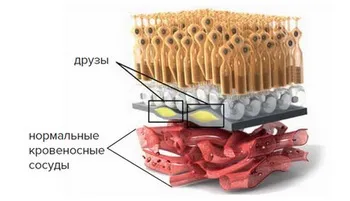 Лікування вікової макулярної дегенерації (дегенерації) Лікування вікової макулярної дегенерації
