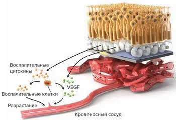 Лікування вікової макулярної дегенерації (вікової) Лікування вікової макулярної дегенерації