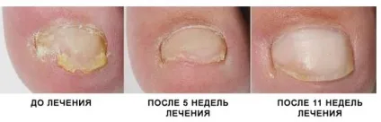 Лікування грибка нігтів лазером різновиди, показання, можливі ускладнення (показання) Лікування грибка нігтів лазером різновиди, показання, можливі ускладнення