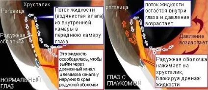 лікування глаукоми