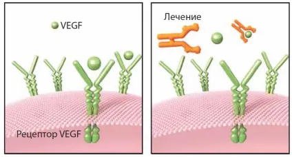 Лікування вікової макулярної дегенерації (вікової макулярної дегенерації) Лікування вікової макулярної дегенерації