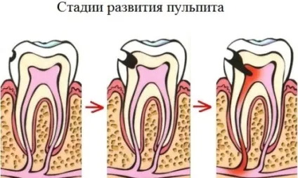 Лікування зубних каналів 1 (лікування) Лікування зубних каналів 1