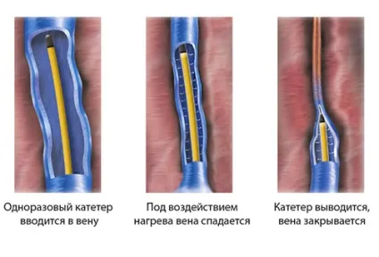Лікування варикозного розширення вен нижніх кінцівок - консервативне і оперативне (Варикозне розширення нижніх кінцівок) Лікування варикозного розширення вен нижніх кінцівок - консервативне і оперативне