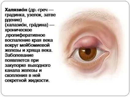 Лікування халязиона у дитини - причини, симптоми і способи видалення у дітей (дитини) Лікування халязиона у дитини - причини, симптоми і способи видалення у дітей