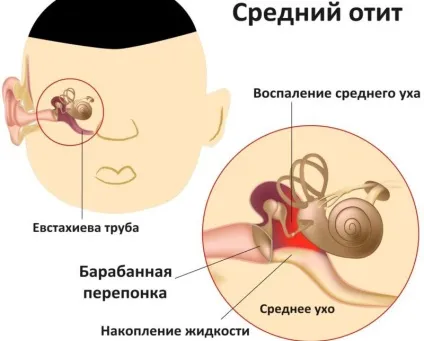 Лікування отиту у дітей народними засобами (народними) Лікування отиту у дітей народними засобами