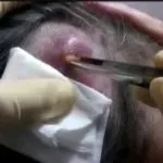 Личинки під шкірою в тілі людини, ногах, фото видалення овода і черв'яків (видалення) Личинки під шкірою в тілі людини, ногах, фото видалення овода і черв'яків