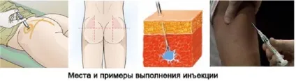 Лидаза при простатиті ефективно засіб лікування (простатиті) Лидаза при простатиті ефективно засіб лікування