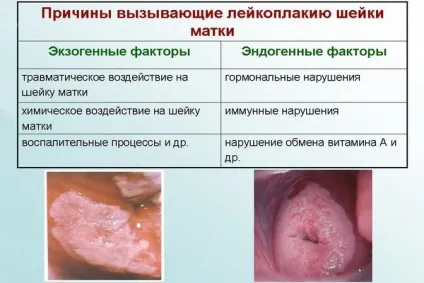 Лейкоплакія шийки матки методи діагностики і лікування, симптоми і види захворювання (діагностики) Лейкоплакія шийки матки методи діагностики і лікування, симптоми і види захворювання