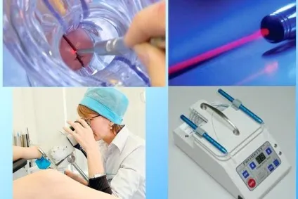 Лейкоплакія шийки матки методи діагностики і лікування, симптоми і види захворювання (лейкоплакія) Лейкоплакія шийки матки методи діагностики і лікування, симптоми і види захворювання