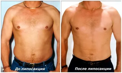 Ліпосакція живота фото до і після, як робиться процедура, чи підходить вона для чоловіків, відео відгуки (після) Ліпосакція живота фото до і після, як робиться процедура, чи підходить вона для чоловіків, відео відгуки