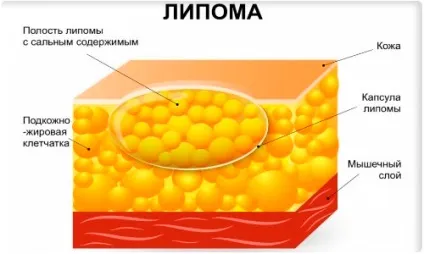Ліпома (жировик) у дітей симптоми, фото і методи лікування (ліпома) Ліпома (жировик) у дітей симптоми, фото і методи лікування