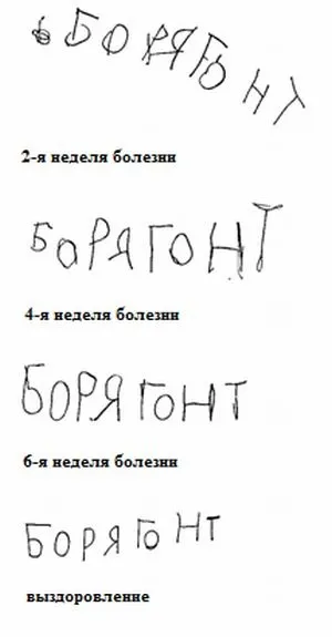 Мала хорея (Сіденгама, ревматичний, інфекційна) симптоми, лікування