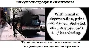 Макулодистрофія суха форма