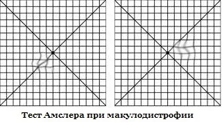 Макулодистрофія суха форма
