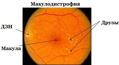 Макулодистрофія суха форма