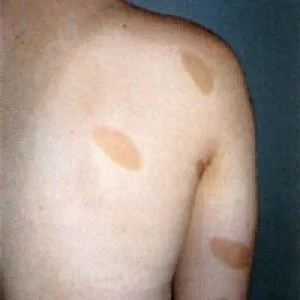 Нейрофіброматоз Реклінгхаузена симптоми і лікування хвороби еклінгхаузена 1 і 2 типу