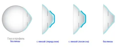 Нічні лінзи для відновлення зору