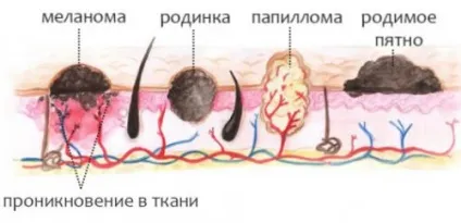 Меланома шкіри прогнози життя що це таке, скільки проживе людина (життя) Меланома шкіри прогнози життя що це таке, скільки проживе людина