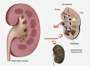 Мінеральна вода для нирок яка корисна, чи можна пити