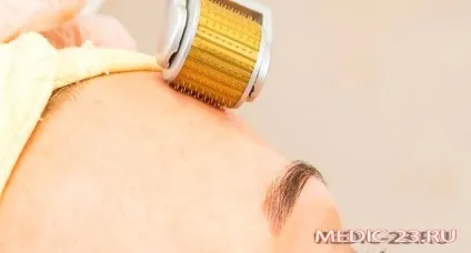Мікронідлінг відгуки про процедуру, оцінка результату, безпеку проведення