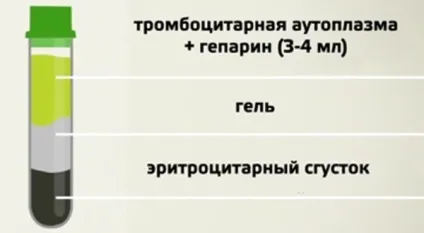 Методика, необхідні умови і протипоказання до проведення Плазмоліфтінг в стоматології, відгуки (протипоказання) Методика, необхідні умови і протипоказання до проведення Плазмоліфтінг в стоматології, відгуки