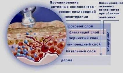 Мезотерапія для схуднення відгуки, протипоказання, результати (мезотерапія для схуднення) Мезотерапія для схуднення відгуки, протипоказання, результати