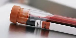 Міозит симптоми, лікування і профілактика в домашніх умовах (міозит симптоми і лікування в домашніх умовах) Міозит симптоми, лікування і профілактика в домашніх умовах