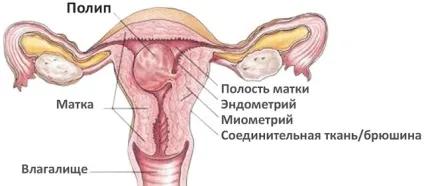 Міометрій що це таке, структура дифузно неоднорідного і однорідного міометрія (дифузно) Міометрій що це таке, структура дифузно неоднорідного і однорідного міометрія