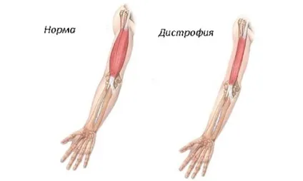 Міопатія у дітей