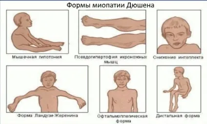 Міопатія у дітей