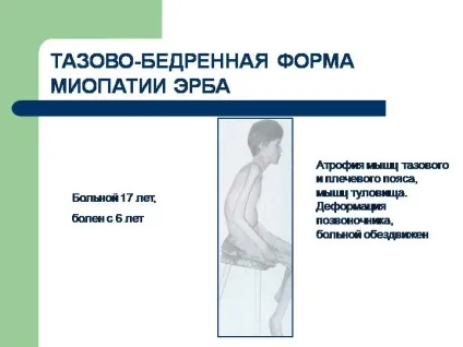 Міопатія у дітей