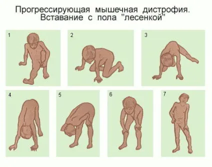 Міопатія у дітей